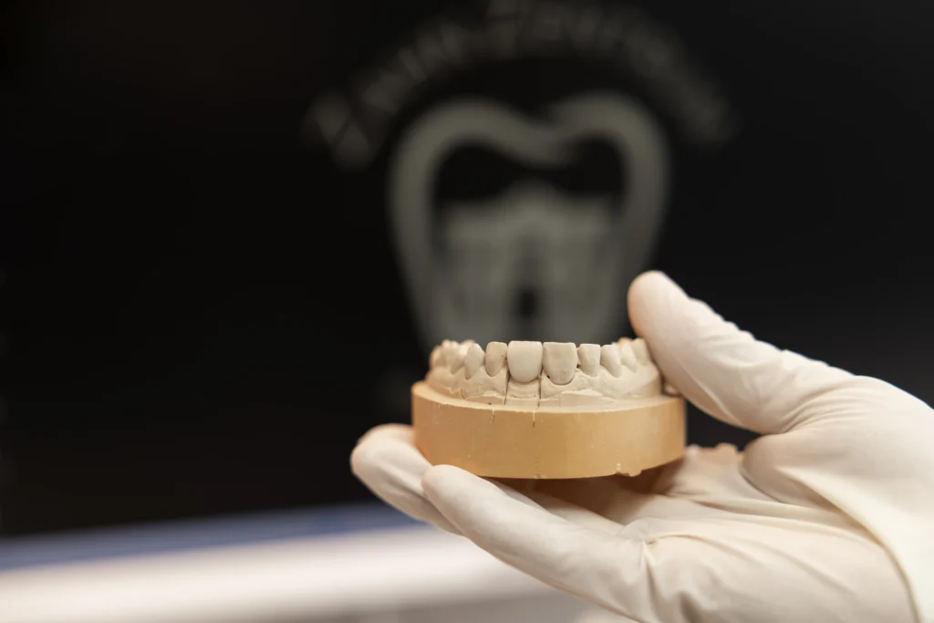 Gipsmodell der Frontzähne aus dem Meisterlabor, Veneers in Bad Oldesloe